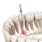 root canal therapy