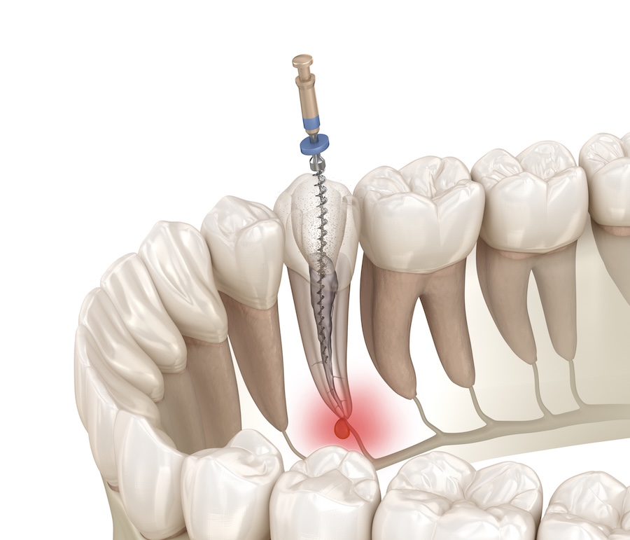 root canal therapy