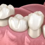 how to care for a tooth after a filling or dental crown