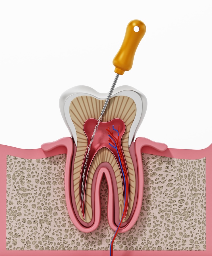 root canal therapy